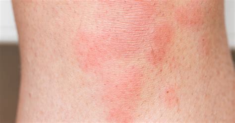 Stress Hives Pictures And Symptoms Stress Rash Or Not