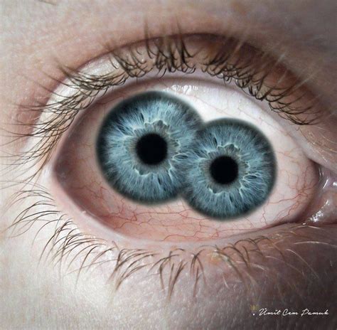 Pupula Duplex Everything You Need To Know About The Rare Double Pupil