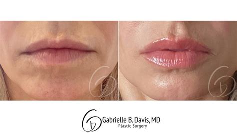 0 5ml Lip Filler Before And After Thin Lips Lipstutorial Org