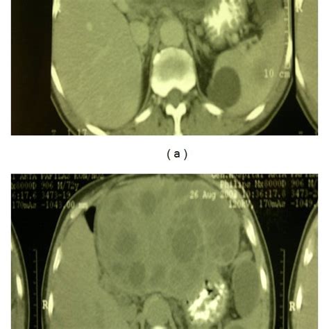 Ct Showed A Large Echinococcal Cyst With Daughter Cysts In The Left