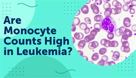 Are Monocyte Counts High In Leukemia Myleukemiateam