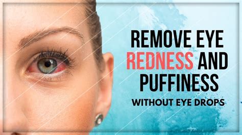 How To Get Rid Of Red Eyes Without Eye Drops Clear Red Eyes Naturally