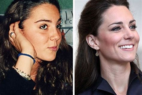 Kate Middleton Plastic Surgery Before And After Celebrity Plastic