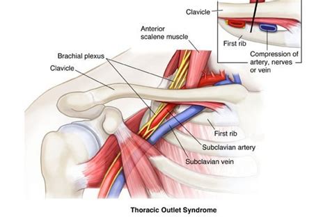 Thoracic Outlet Syndrome Jonathan Collier Injury Rehabilitation