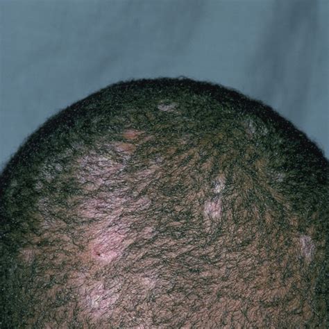 Common Scalp Conditions Pictures Causes And Treatments