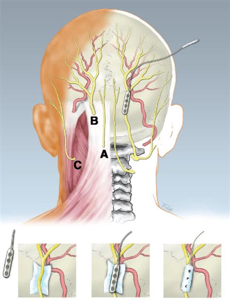 Figure 202 From Occipital Nerve Stimulation For Intractable Occipital