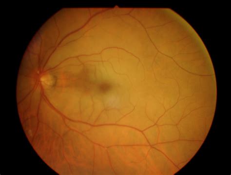 Retinal Artery Occlusion Eyewiki