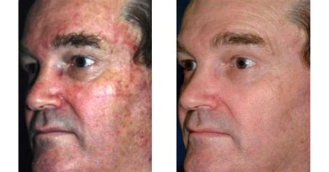 Co2 Laser Resurfacing Face How To Get Rid Of Hyperpigmentation Here