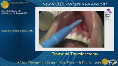 Transoral Thyroidectomy YouTube