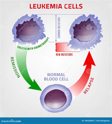 Leukemia Medical Infographic Stock Vector Illustration Of Human