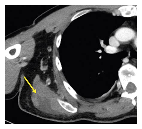 A Coronal Images From A Contrast CT Of The Thorax Showing Right