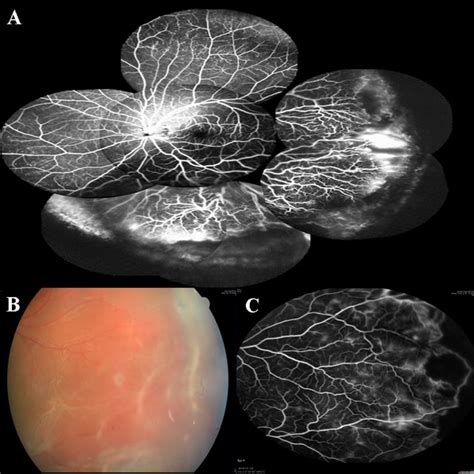 Color Fundus And Fa Photos Of Group 3 Eyes A Fluorescein Angiography