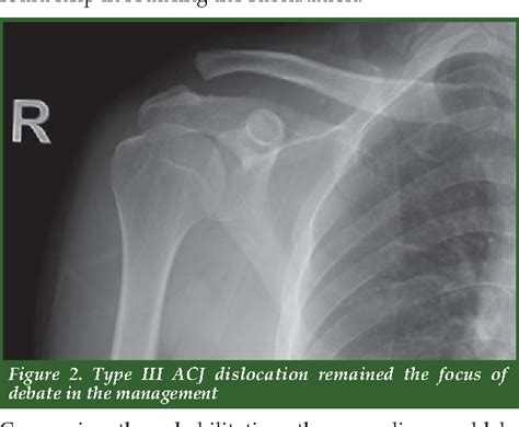 Figure 2 From Distal Clavicle Fractures And Acute Acromioclavicular