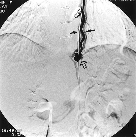 Late Internal Mammary Arteriovenous Fistula Circulation