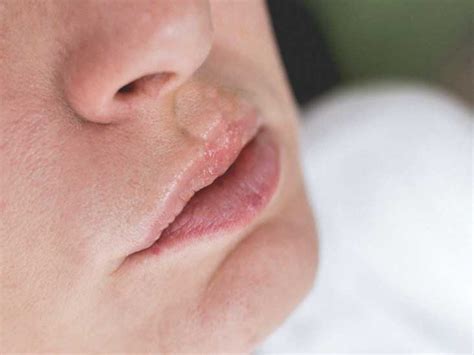 Swollen Lips From Being Sick Lipstutorial Org
