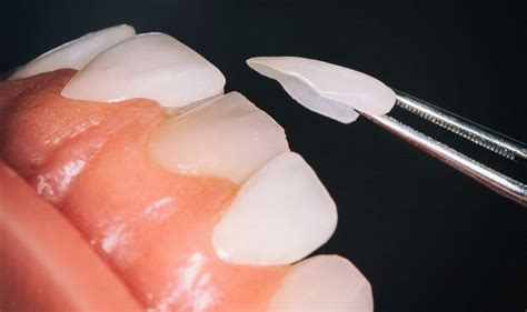 Tips For Long Lasting Porcelain Dental Veneers Financial District