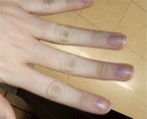 Raynauds Disease And Lupus Syndrome Lupus Raynaud Blue Hands Fingers
