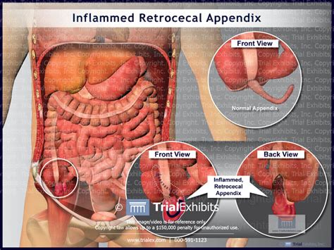 Inflamed Retrocecal Appendix Trial Exhibits Inc