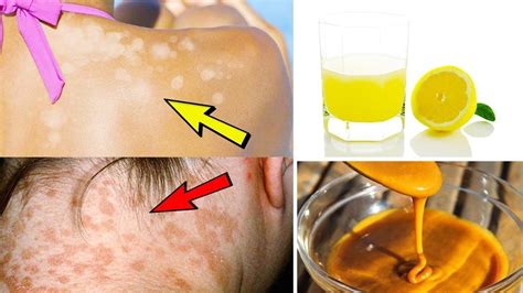 Pin On Natural Home Remedy