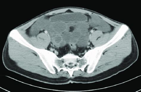 An Abdominal And Pelvic Ct With Enteric And Intravenous Contrast Shows