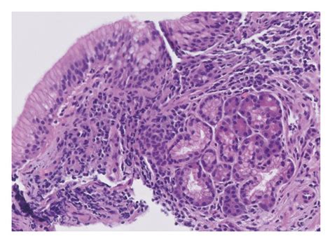 Histopathology Of The Distal Esophageal Submucosal Lesion Showing A