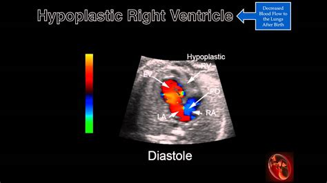 Fetal Echocardiography Hypoplastic Right Ventricle Youtube