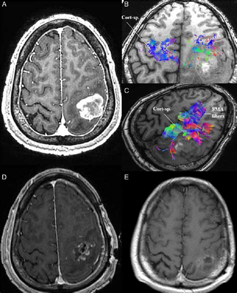 A Mri Of The Brain In Case Demonstrated A Contrast Enhancing Lesion Download Scientific