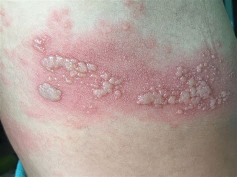 Eczema Numular Causas Sintomas E Tratamentos 【atualizado】
