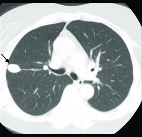 Ct Scan Chest Without Contrast Ct Chest Without Contrast Showing