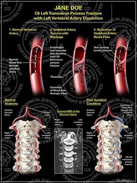 Bilateral Carotid Vertebral Artery Dissection Awareness Ideas Vertebral Artery Arteries