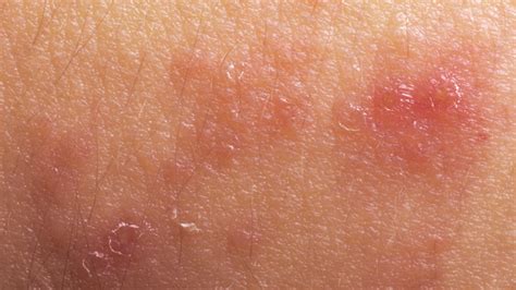 Armpit Rash Fungal Images Galleries With A Bite