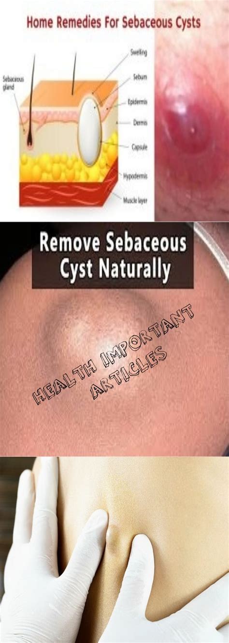 13 Natural Home Remedies For Sebaceous Cyst Health Important Articles