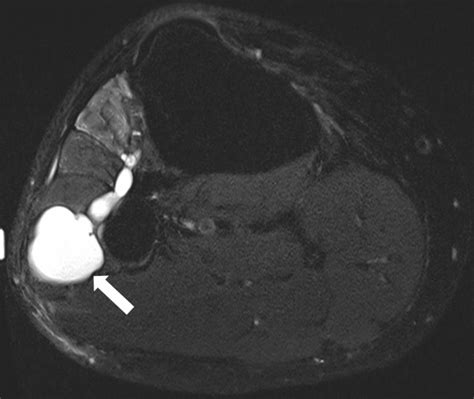 Cureus Recurrent Peroneal Intraneural Ganglion Cyst Management And
