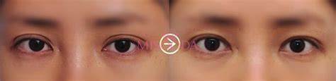 why korean double eyelid surgery guide reviews promotions misooda