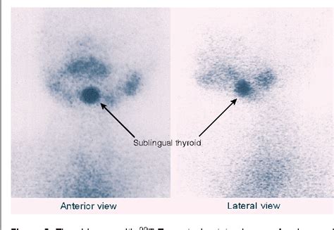 Pdf The Ectopic Thyroid Gland And The Role Of Nuclear Medicine