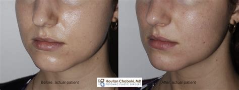 How To Reduce Cheek Size Aimsnow7