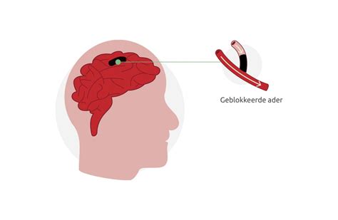 Herseninfarct Oorzaken En Gevolgen Koninklijke Otolift