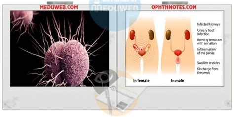 Gonorrhea Causes Diagnosis And Treatment Meduweb