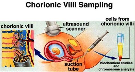 Has a few more colorful definitions of cvs. the one that i particularly like, though, is chocolate, vanilla, strawberry, the three flavors in. Chorionic Villus Sampling - What is?, Definition, Risks ...