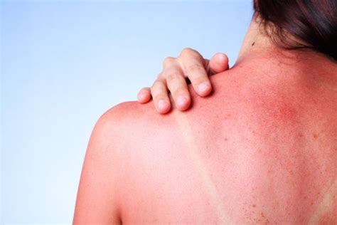 5 Signs Your Sunburn Is Actually Sun Poisoning