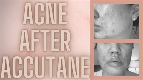 My Acne Came Back After Accutane What Caused It What I Tried And What Worked Youtube