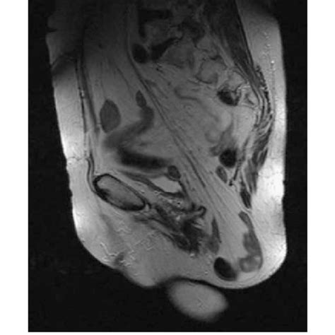 Transversal Magnetic Resonance Image Showing Para Rectal Hernia