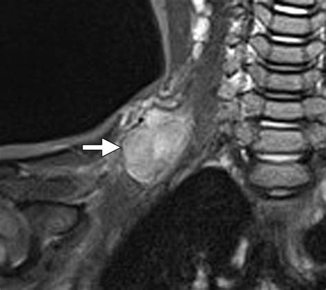 Soft Tissue Tumors Of The Head And Neck Imaging Based Review Of The