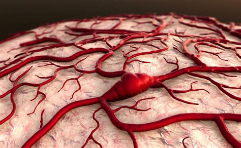 What Is An Arteriovenous Malformation American Stroke Association