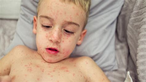 What Is Measles Rubeola Causes Symptoms And Treatments Goodrx