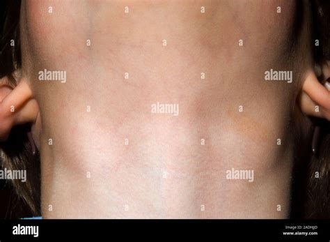 Swollen Lymph Glands In The Neck Of A 4 Year Old Boy The Swollen