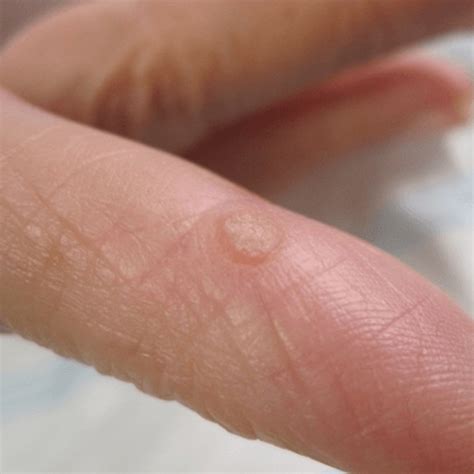 How To Get Rid Of Warts On Hands And Fingers What Causes Warts On