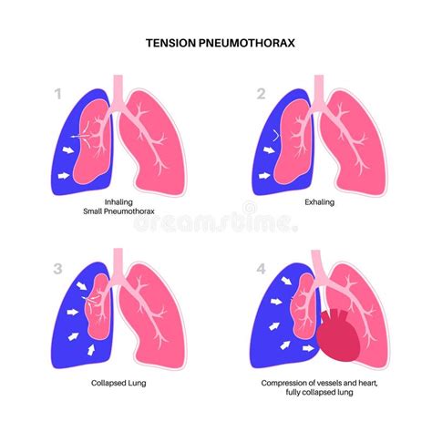Tension Pneumothorax Poster Stock Illustration Illustration Of Wall