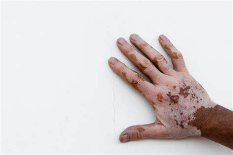 Tangan Manusia Yang Terkena Vitiligo Terisolasi Di Latar Belakang Putih