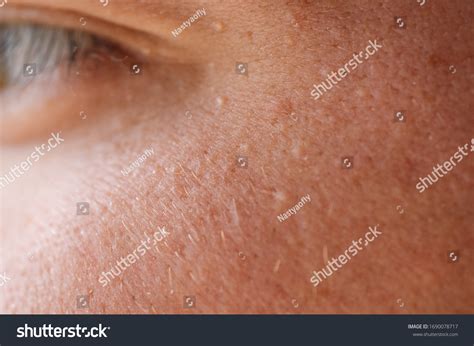 Milia Milium Pimples Around Eye On Stock Photo Edit Now 1690078717